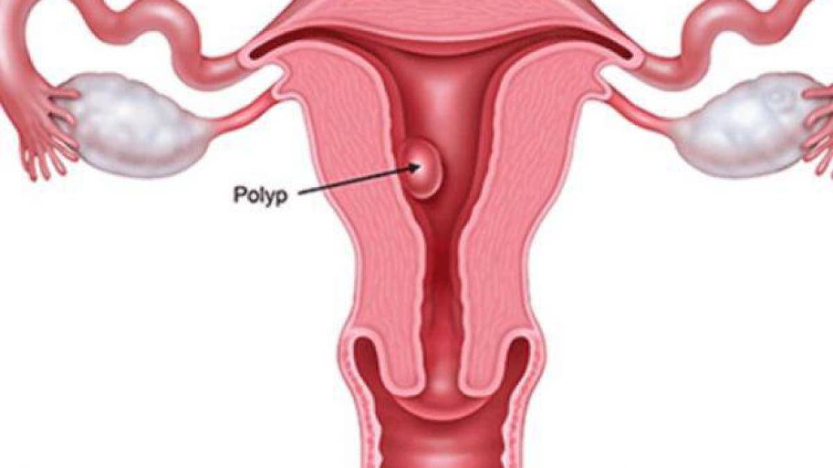Polyp tử cung - Hình ảnh minh họa